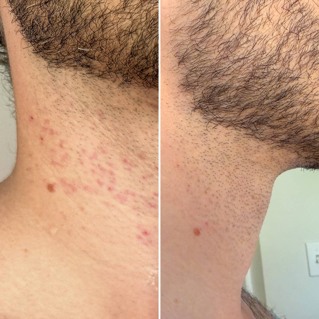 BRUH. THE RECOVERY MIST with Hypochlorous Acid